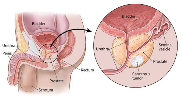 Kanker Prostat
