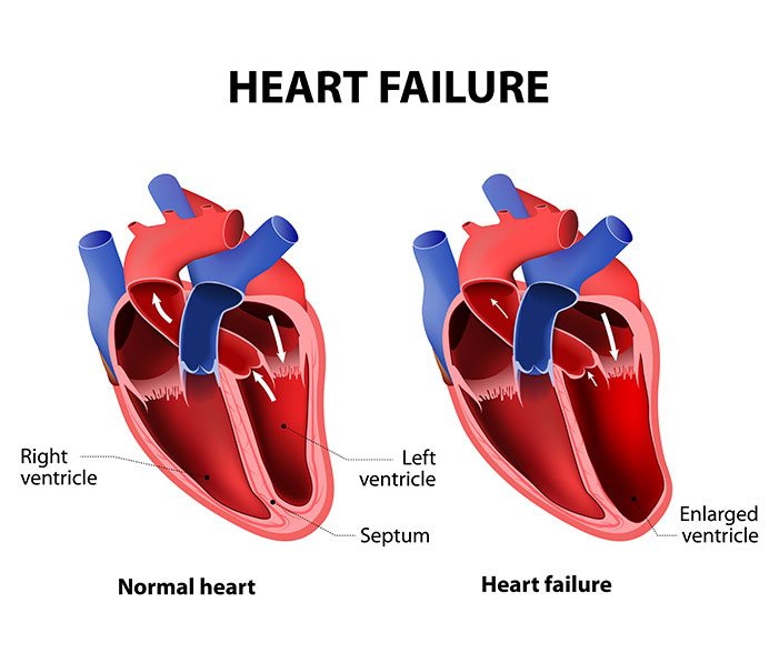 gagal jantung