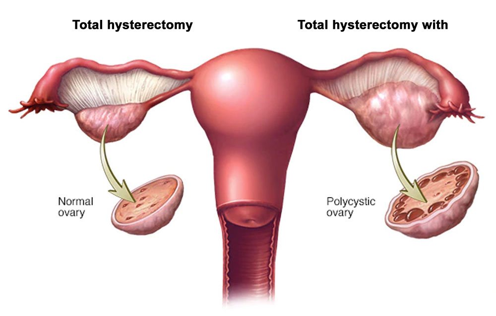 Polycystic ovary syndrome