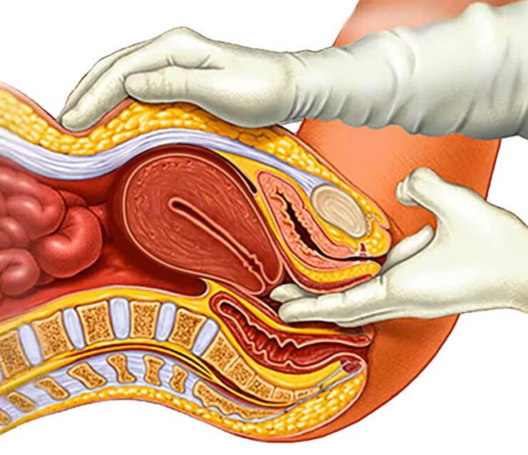 Polycystic ovary syndrome