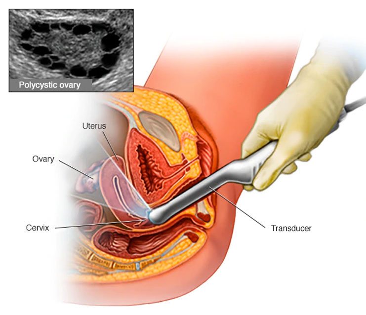 Polycystic ovary syndrome