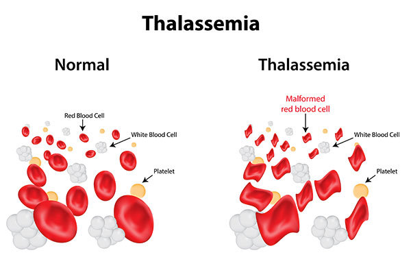 Thalasemia