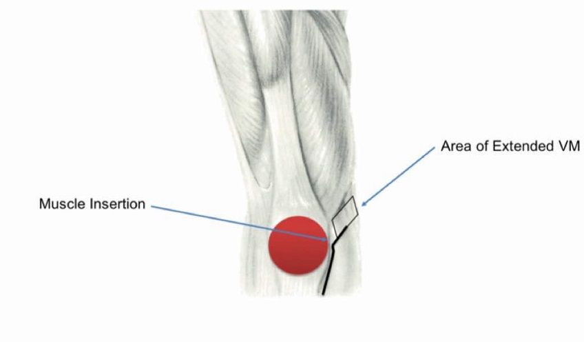 partial knee replacement