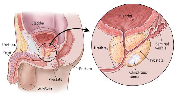 kanker prostat