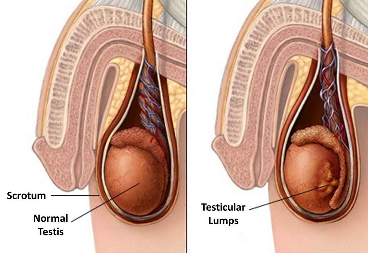 kanker testis