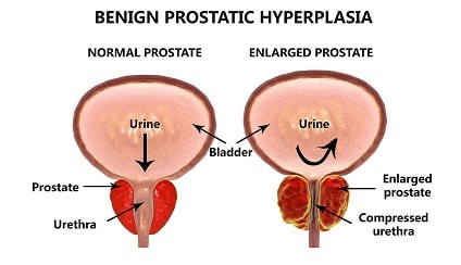 pembesaran prostat