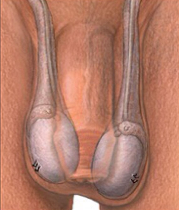 torsio testis