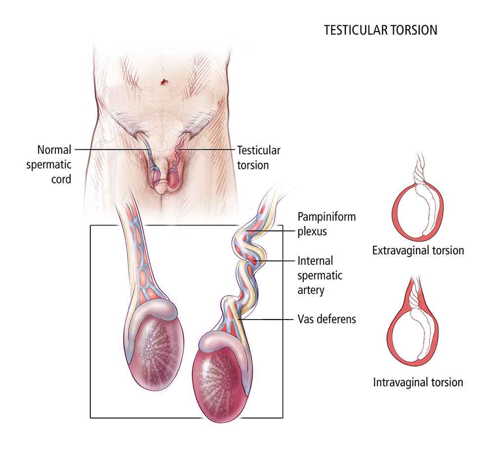 torsio testis