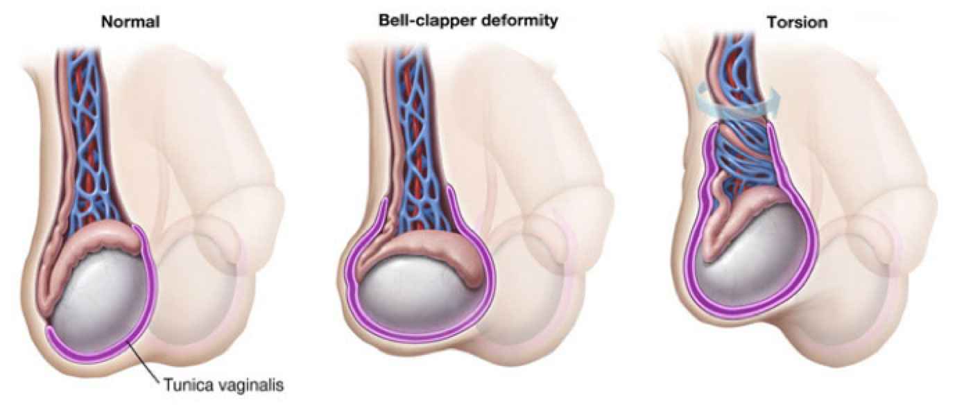 torsio testis