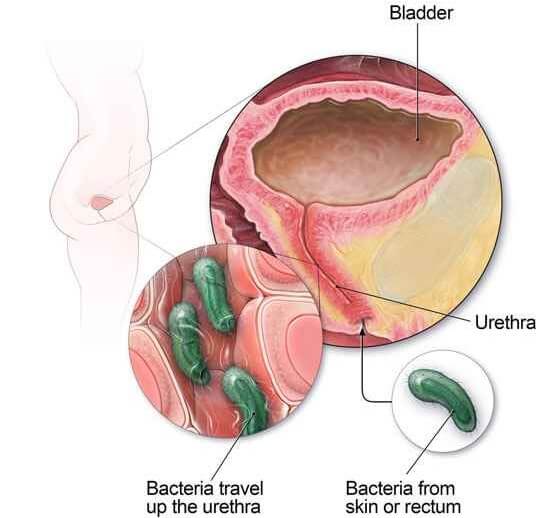 infeksi saluran kemih